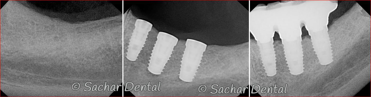 Picture of Before and after x-rays of bone graft plus dental implant