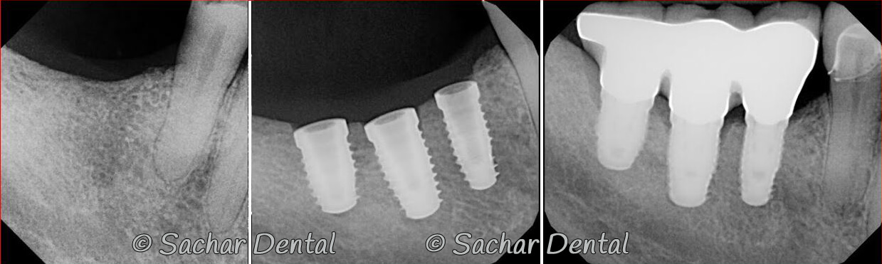 Picture of Before and after x-rays of bone graft plus dental implant