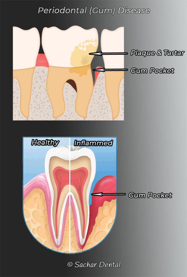 Picture of diagram of periodontal disease, two pictures
