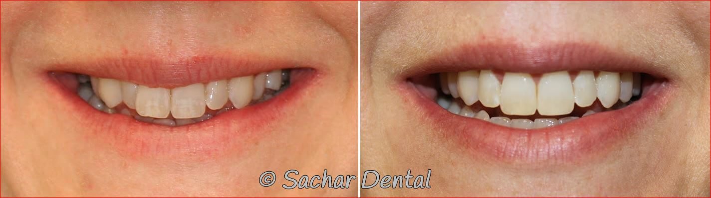 Cosmetic Dentistry at Sachar Dental NYC