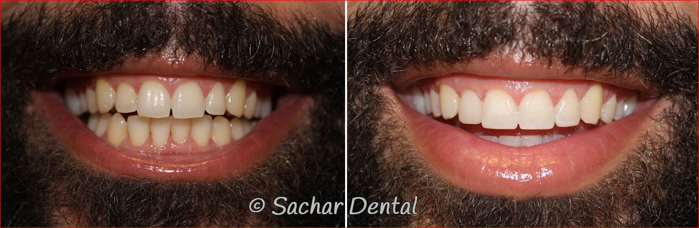 Before and after pictures of resin bonding veneers