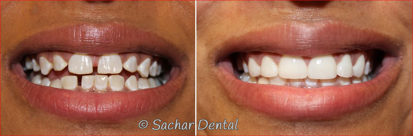 Top NYC Cosmetic Dentist for Porcelain Veneers