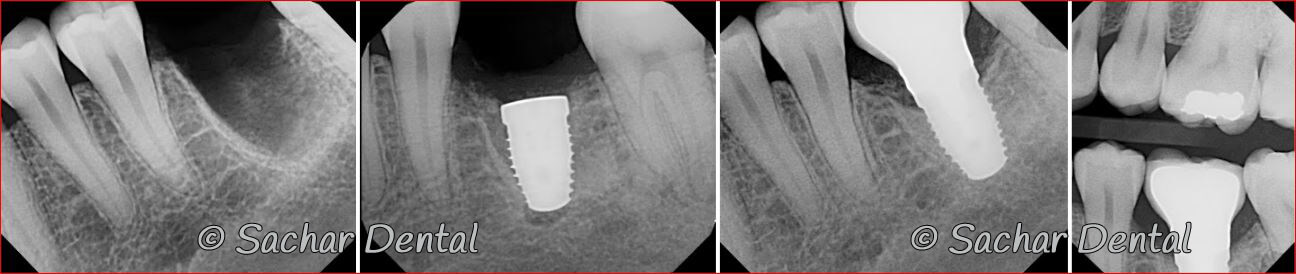 Picture of Before and after x-rays of tooth extraction and dental implant plus bone graft