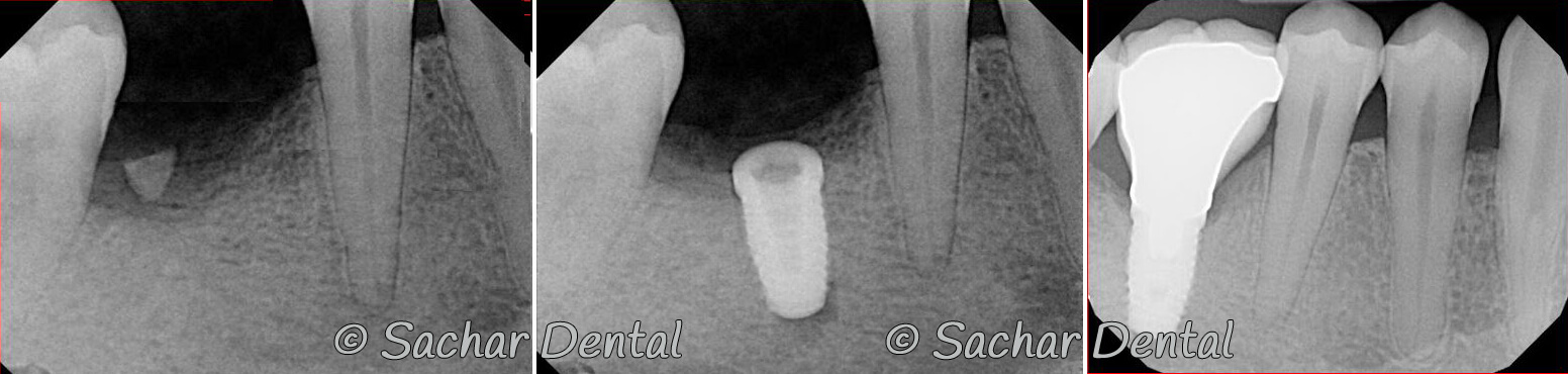 Picture of Before and after x-rays of dental implant after a tooth extraction