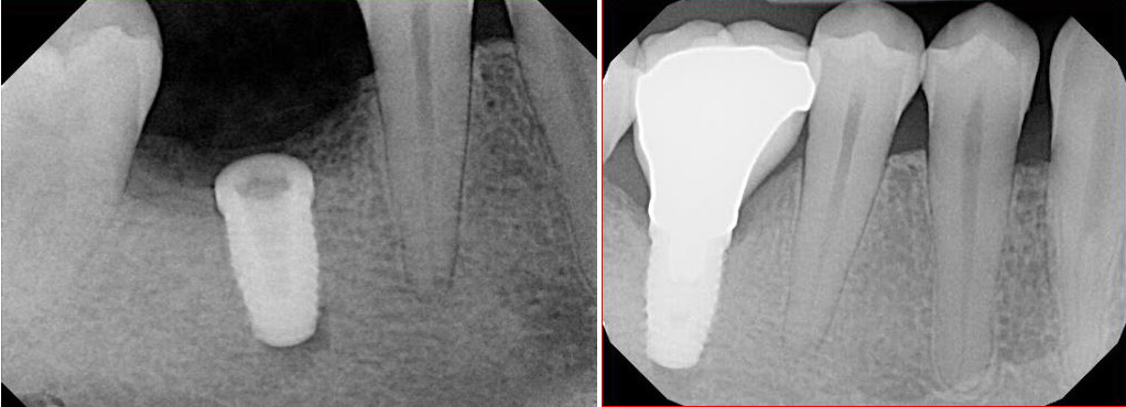 Picture of Before and after x-rays of dental implants and bone graft