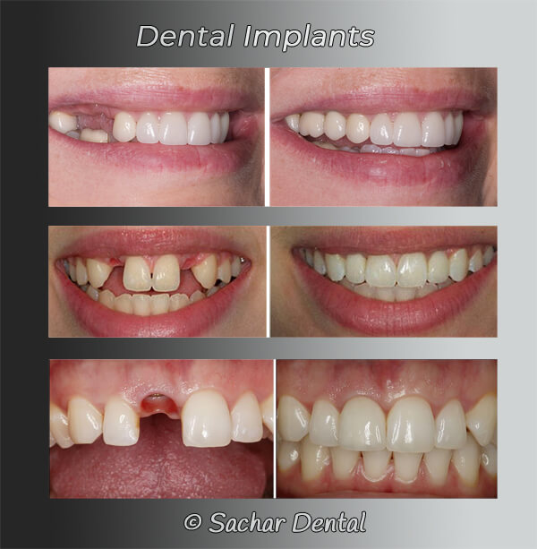Picture of 3 before and after pictures of patients who had dental implants