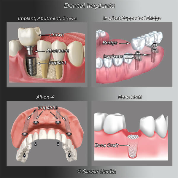 Picture: Diagrams explaining dental implants including implants, abutment, crown, implant supported bridge, all on 4, bone grafting
