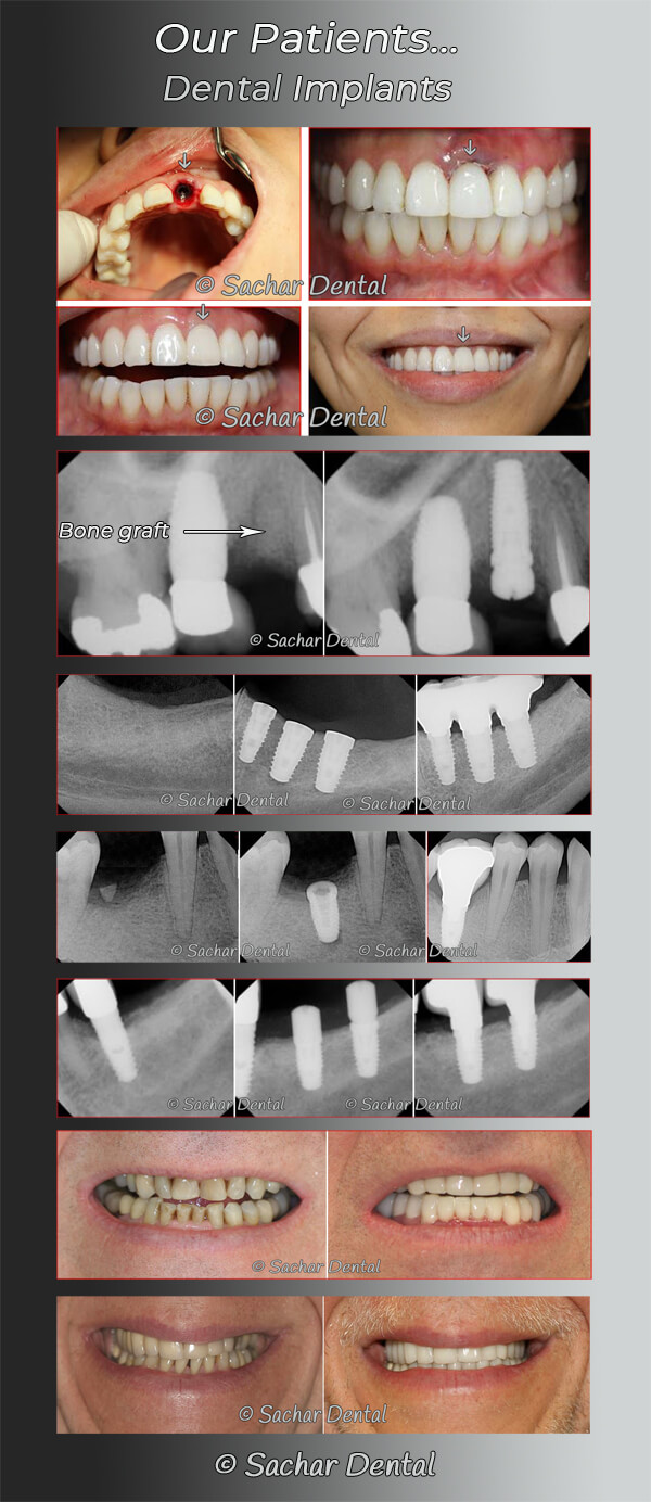 Picture description: Before and after picture of our patients with dental implants multiple patients with x-rays and clinical pictures