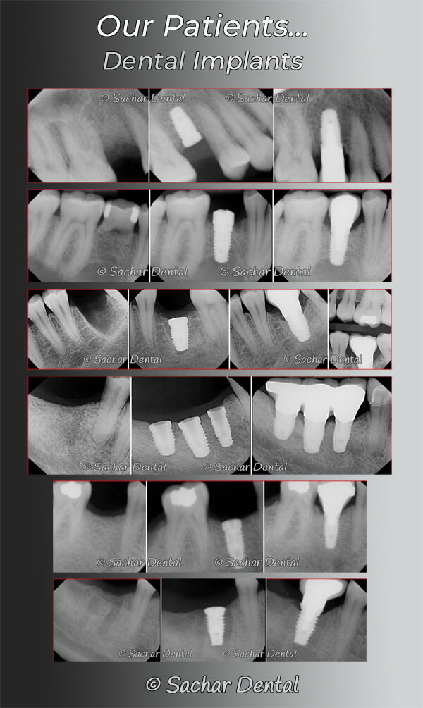 Picture of 6 before and after x-rays of our patients who had dental implants