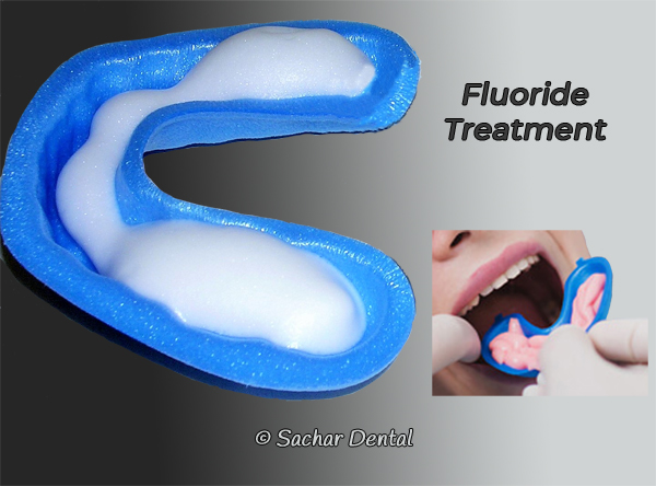 Dentist NYC fluoride treatment