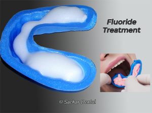 Dentist NYC for fluoride treatment