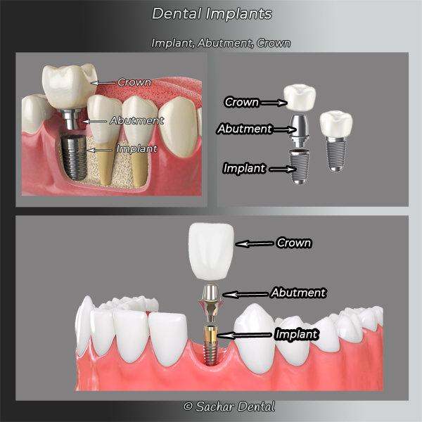 NYC Dentist for Implant Crown