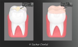 Dentist NYC for Inlays Onlays