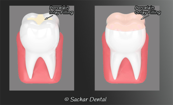 Dentist NYC for Inlays Onlays