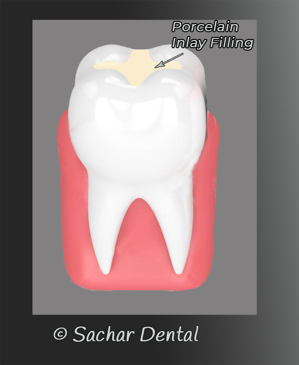 Dentist NYC for porcelain Inlay - diagram