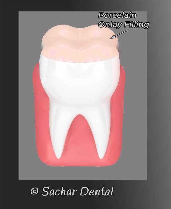 NYC Dentist for Porcelain Onlay - diagram