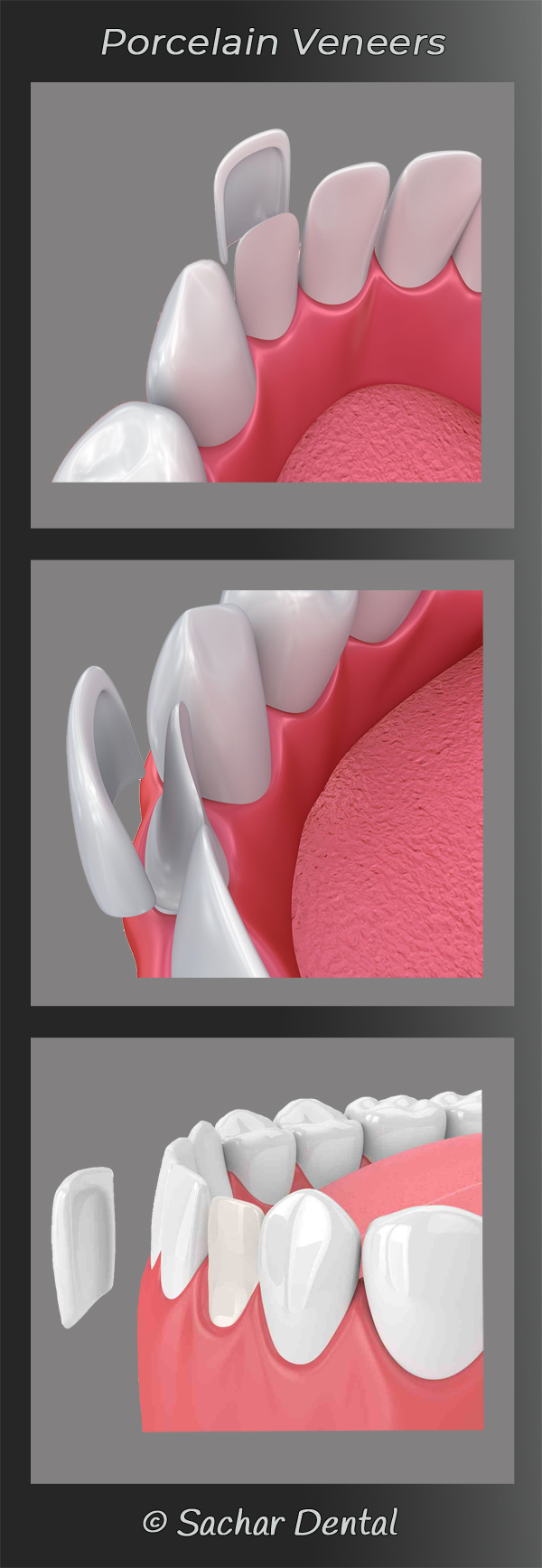 Porcelain veneers NYC diagram illustration