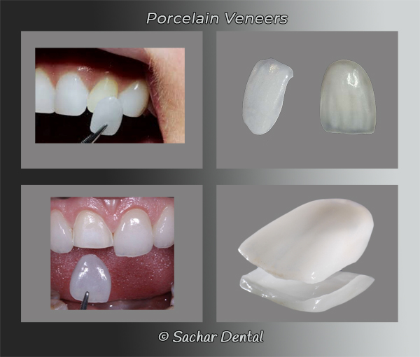 Porcelain Veneers NYC diagram