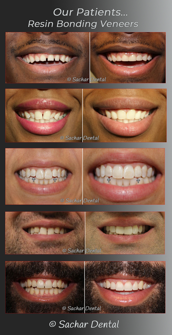 Resin Bonding veneers NYC- Picture of multiple before and after pictures of patients who have had resin bonding veneers