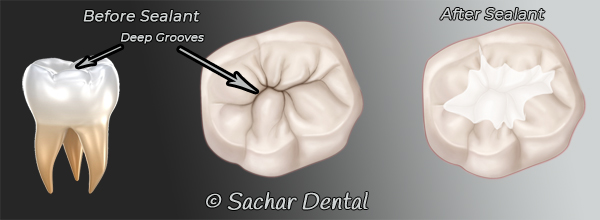 Dentist NYC for dental sealants