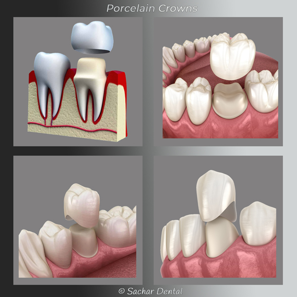 Dentist NYC porcelain crowns cosmetic dentist Porcelain Crown NYC- Cosmetic Dentistry NYC