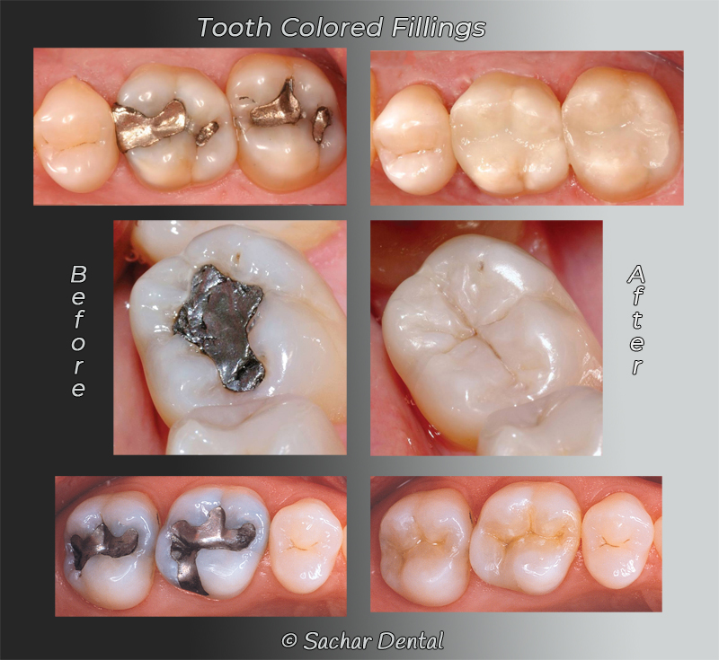 Cosmetic Dentist NYC for tooth colored fillings