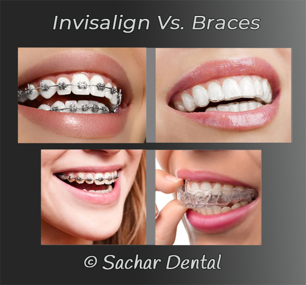 Braces or Invisalign – Comparison – What Works Better?