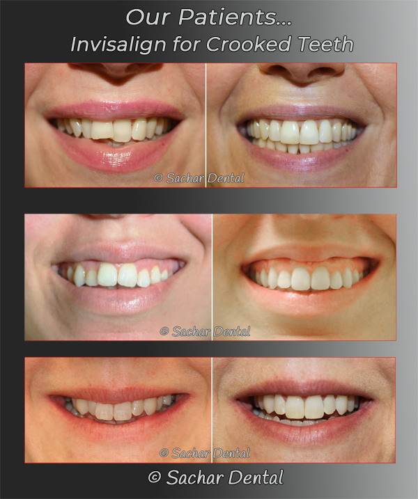 Picture of Invisalign before and after for crowded teeth 3 patients