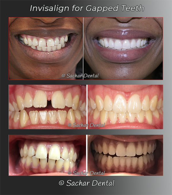 Picture of before and after Invisalign treatment for gapped teeth 3 patients