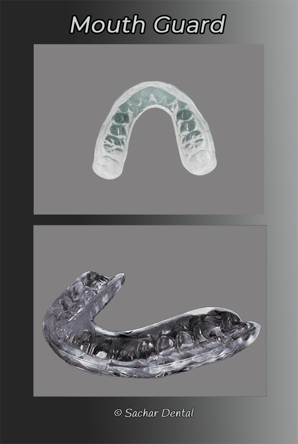 The Many Benefits of Mouth Guards: Smile Design Manhattan: Cosmetic  Dentistry