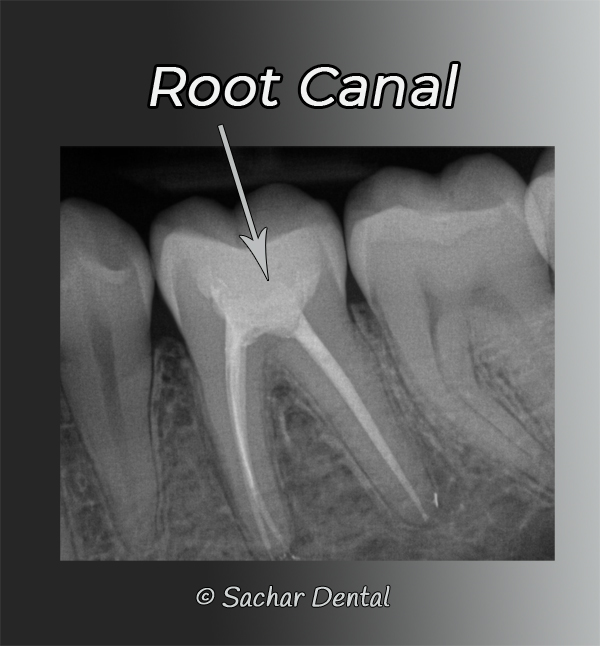 NYC Dentist for root canals- xray