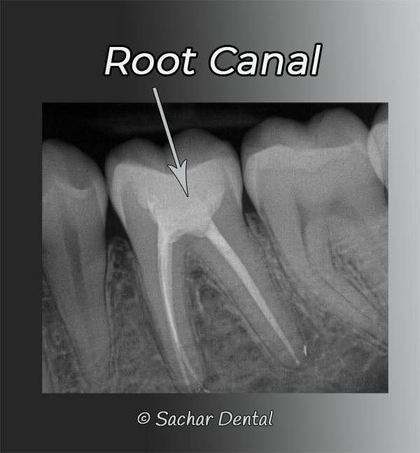 tooth that needs root canal