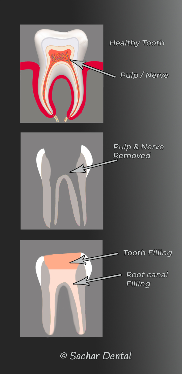 Dentist NYC- root canal diagram