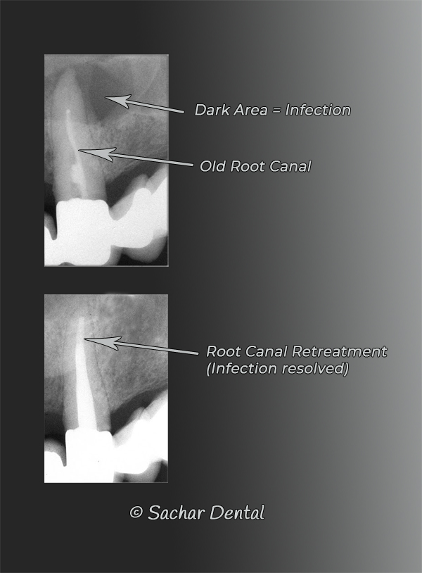 NYC Dentists for root canal - xray