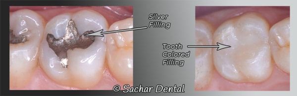 Cavity Filling in Brooklyn NY