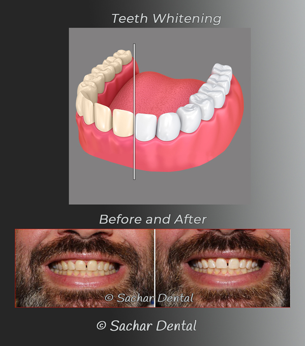 Teeth whitening NYC-diagram and picture Sachar Dental NYC