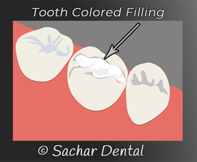 Tooth colored fillings NYC- Cosmetic Dentistry