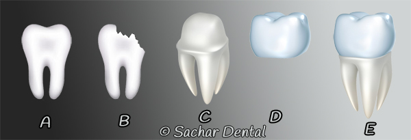 Dentist NYC for dental crown- diagram