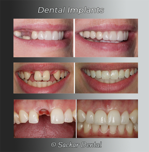 Best Dentist NYC for Dental Implants