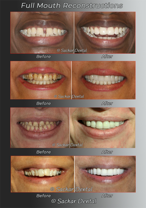 Dentist NYC for complex full mouth reconstruction dentistry before and after pictures