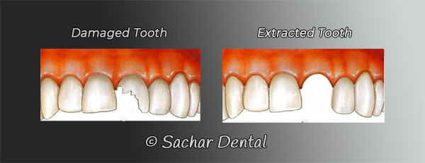 Dentist NYC for tooth extractions- diagram