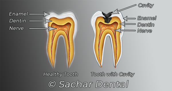 diagram of before and after cavity dentist nyc v02 W600