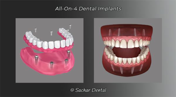 Picture of All-on-4 dental implants two diagrams
