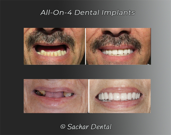 Picture of before and after patients with all-on-4 dental implants, 2 different patients