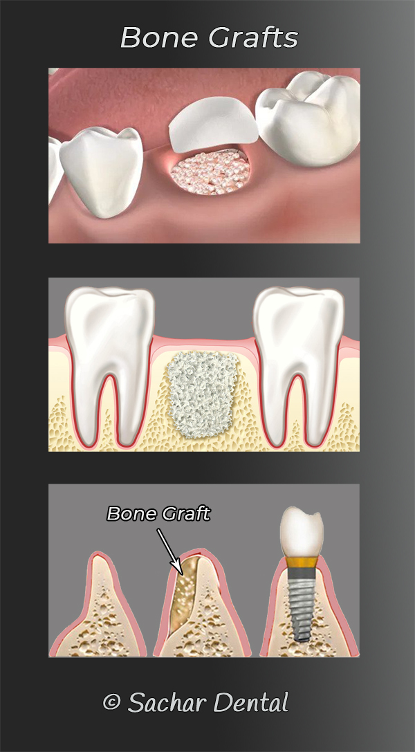 Picture of diagrams of bone grafting for Dental implants