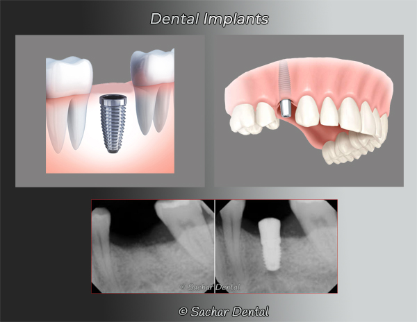 Dental implants diagrams of implant, abutment, and crown
