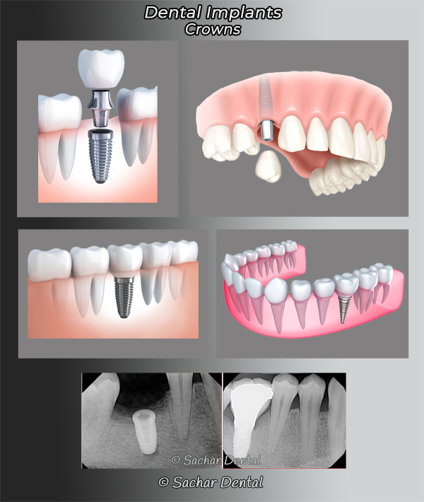 Picture of diagrams and x-ray of crowns attached to dental implants