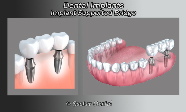 Picture of diagram of dental implants supported Bridge