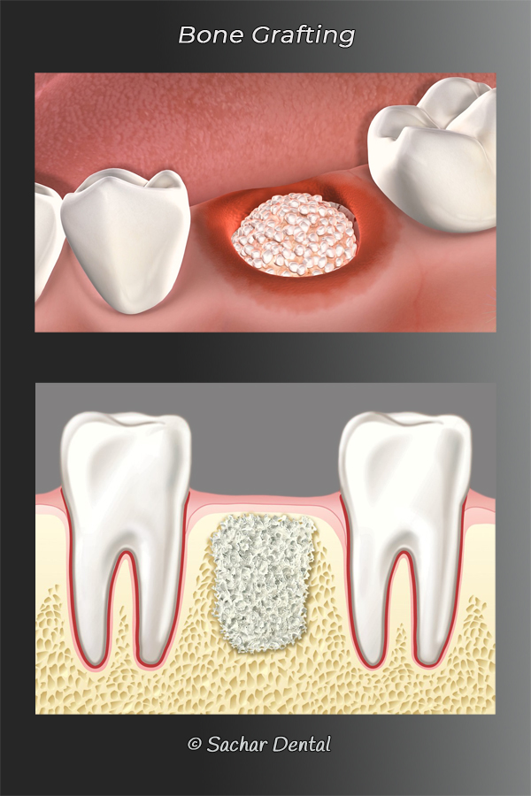 Picture of 2 diagrams explaining periodontal bone grafting for dental implants