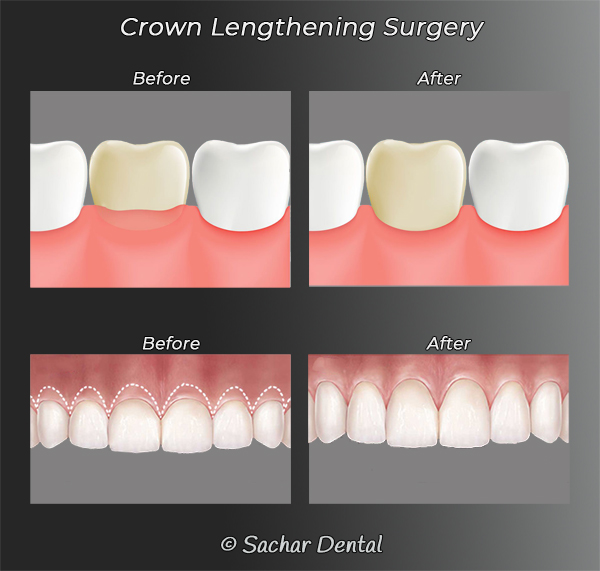 Picture of diagrams explaining periodontal crown lengthening surgery